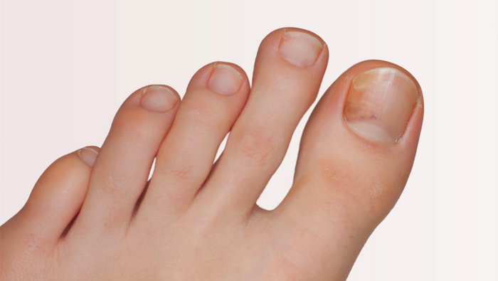 Nagelpilz